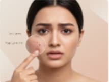 Dark Spots & Hyperpigmentation